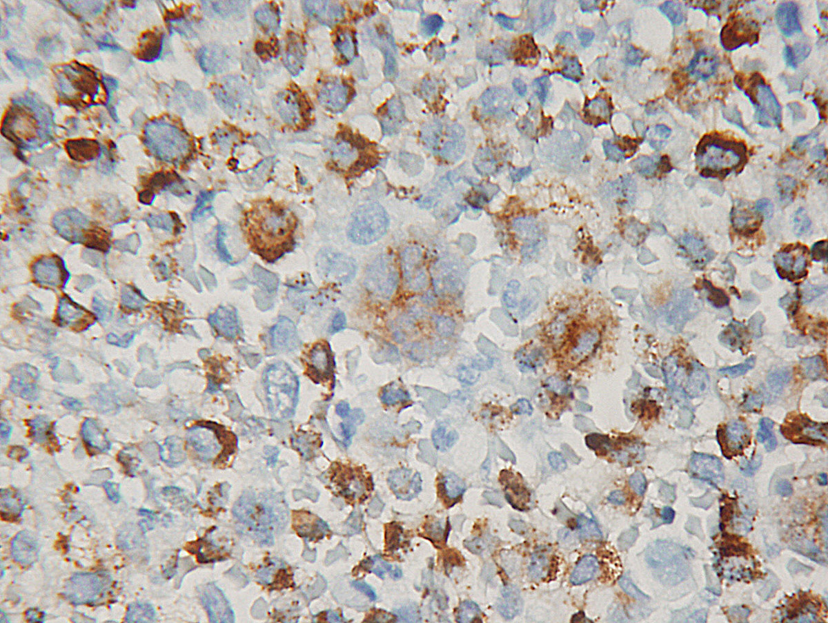 Some large multinucleated cells were positive for mast cell tryptase